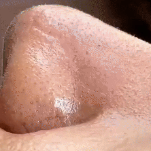 Aspiradora Facial Milagrosa